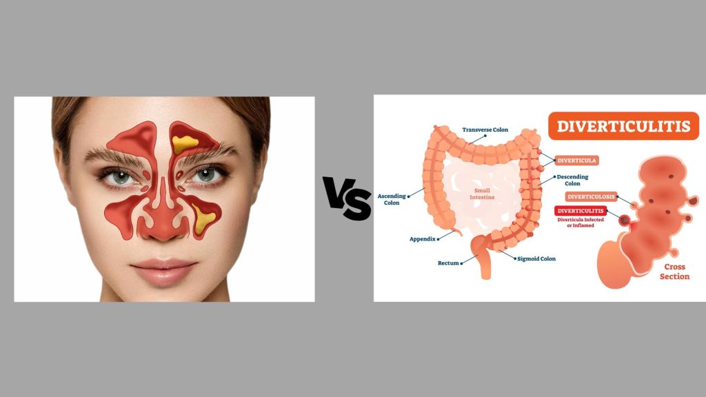 Understanding the Differences: Chronic Sinusitis and&nbsp;Diverticulitis